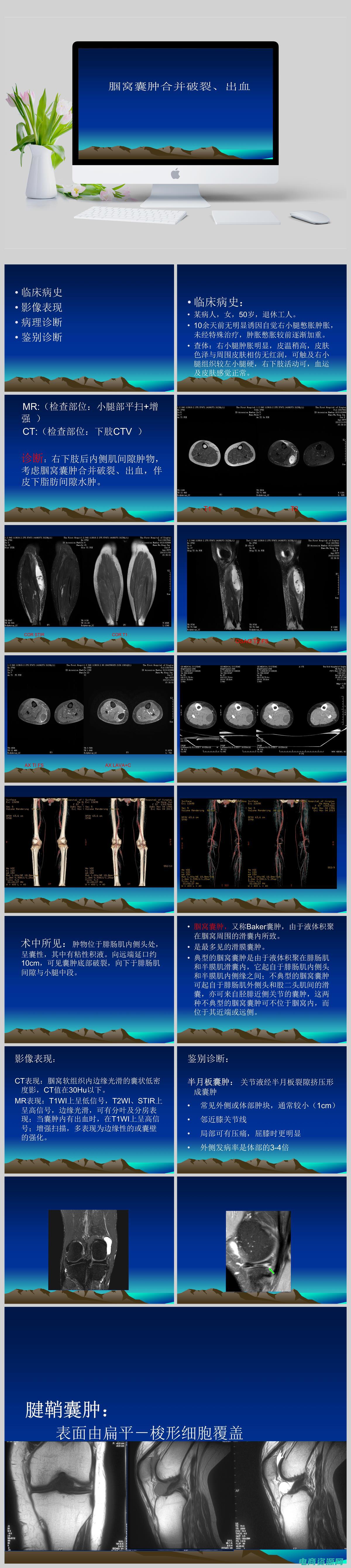 腘窝腘窝位置图